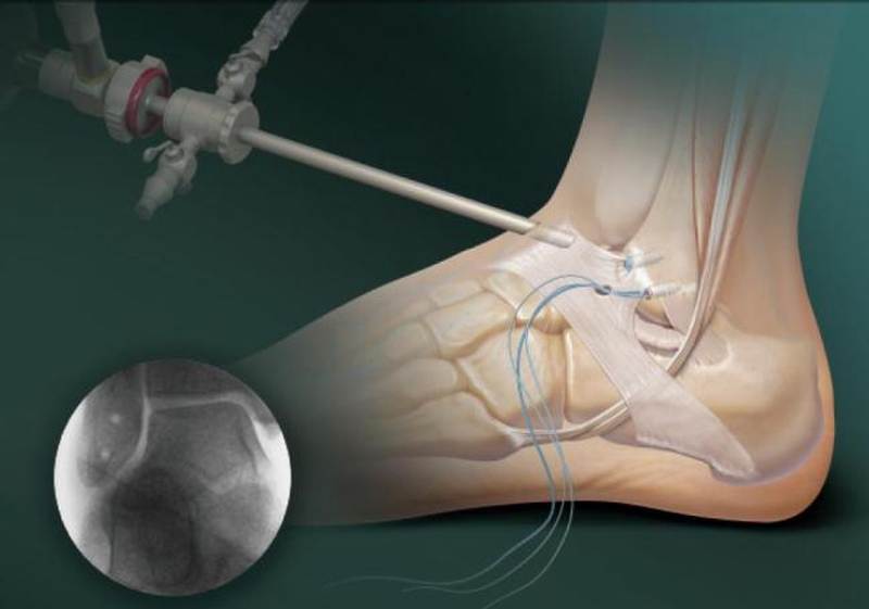 Во время операции хирург вводит в полость сустава артроскоп